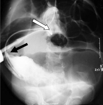The contrast enema image demonstrates a tapering of the contrast column (black ...