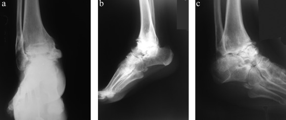 (a–c). Preoperative anteroposterior-lateral and oblique X-ray views of ...