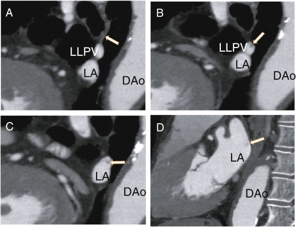 A: Sagittal images showing the left lower pulmonary vein and the non-contrast ...