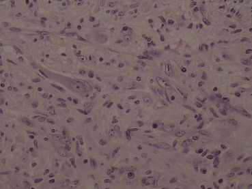 Photomicrograph showing a conspicuous admixture of lymphocytes and plasma cells ...