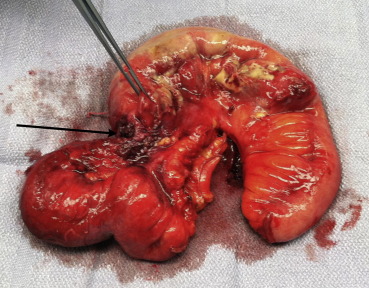 Postoperative specimen of the resected segment of the small bowel showing its ...