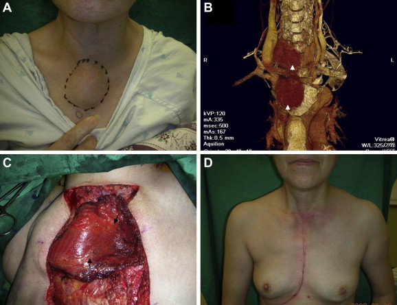 (A) A 55-year-old lady presenting with a painful solitary mass over the upper ...