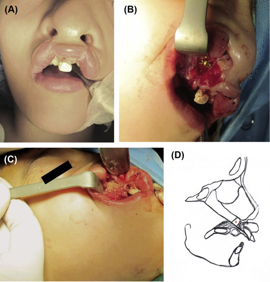 (A) Protruded premaxilla and whistle lip deformity. (B) Lip split, setback of ...