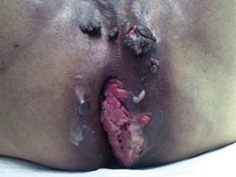 Pre-operative status of the disease.