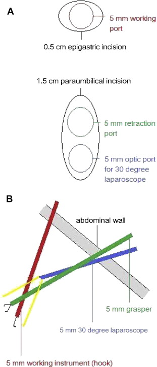 (A) The skin incisions and port insertions during stage one of a two-incision ...