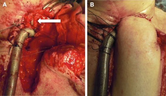(A) Esophageal mucosa was sutured around the split thickness side of the ...