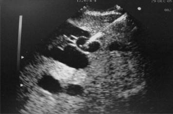 Endoscopic ultrasound view of needle punctured through the gastric wall into the ...