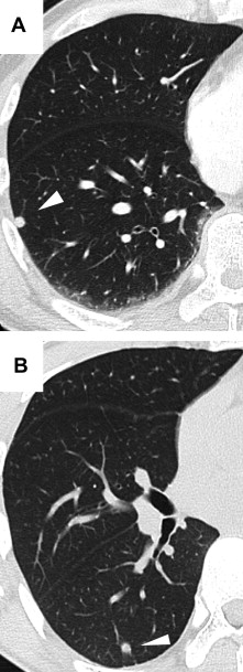 (A) Chest computed tomography revealed a small, round nodule in the lower lobe ...