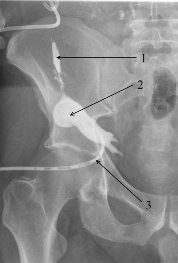 Subcutaneous fat abscess fistulography: (1) sinus tract leading to the pancreas ...