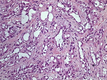 Tumor adenomatoide paratesticular – células epitelioides ou endotelioides ...