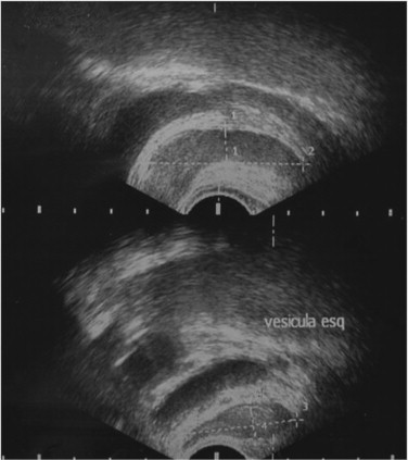 Transretal Ultrasound of patient seminal vesicles (megavesicles).