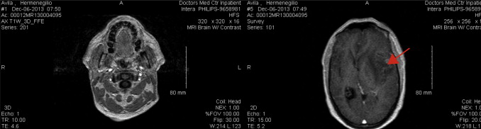 Identifica‐se lesão com 5cm de maior eixo no córtex frontal à esquerda em ...