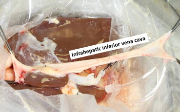 Infrahepatic inferior vena cava was retrieved with the liver graft from the ...