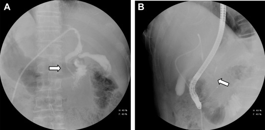 (A) Cholangiogram via percutaneous transhepatic cholangial drainage shows lumen ...