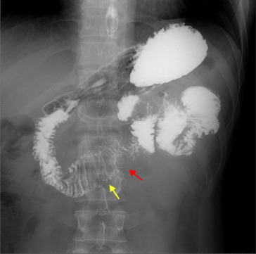 Jejunal polypoid lesion (red arrow) with increasing folds and lumen dilatation ...