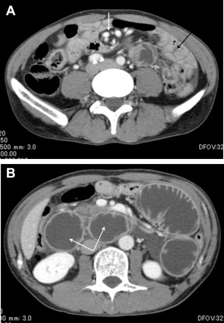(A) Abdominal enhanced computed tomography showed a whirl sign (white arrow) and ...