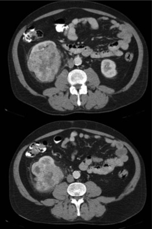 TAC toraco‐abdomino‐pélvica de reestadiamento, realizada em Portugal, 6 meses ...