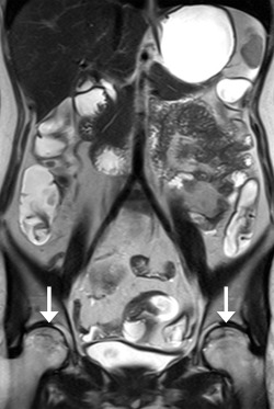 The same patient as in Figure 3. Coronal T2-HASTE image shows hypointense ...