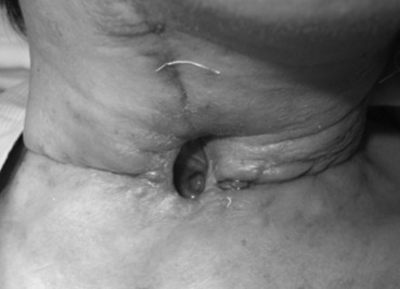 Tracheoesophageal fistula on the posterior wall of the trachea was observed ...