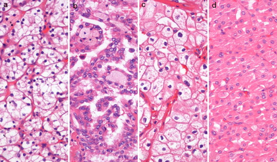 Renal cell tumors (RCTs) morphology: (a) clear cell renal cell carcinoma ...