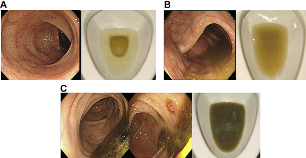 Bowel preparation: (A) shows excellent or good bowel preparation (left panel) ...