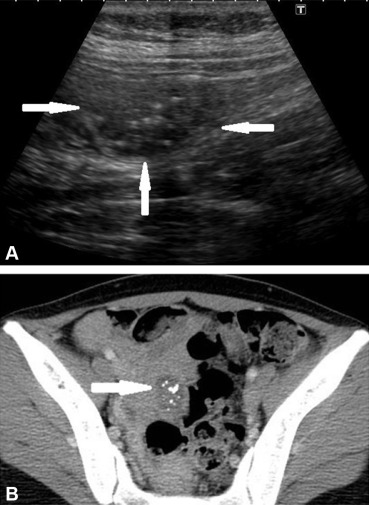 (A) Transabdominal ultrasonography shows a 2-cm hypoechoic lesion (arrows) ...