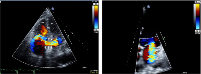 Transthoracic two-dimensional apical four chamber views with color Doppler ...