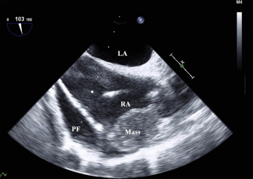 Transesophageal echocardiography reveals massive pericardial fluid collection ...