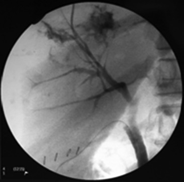 Operative cholangiogram: contrast extravasation via right anterior bile duct ...