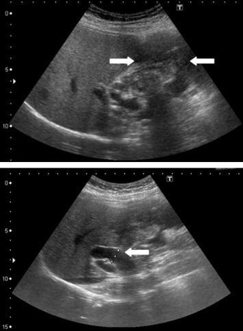 Abdominal ultrasonography showing one mixed echogenic tumor approximately 9.5 cm ...