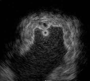 Endoscopic ultrasonography imaging. Circumferential thickening of second and ...