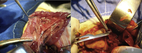 Photograph of: (A) common bile duct ligation; (B) safe decompression of the ...