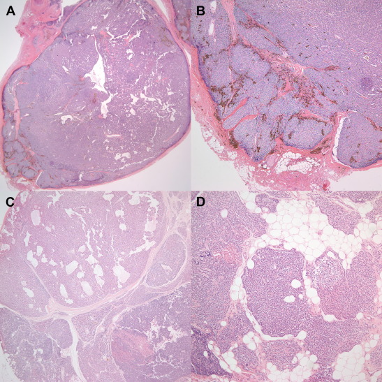 (A) Microscopic finding shows infiltrative parathyroid carcinoma with growth ...