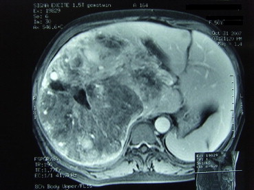 MRI showing peripheral angiomatous component, a fatty component and prominent ...