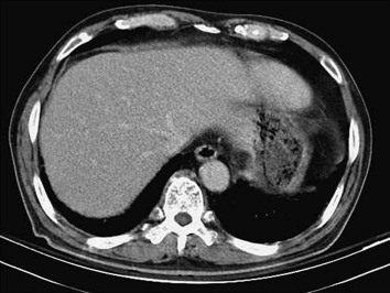 No abnormal intrahepatic ducts dilatation and no biliary tree filling defects.