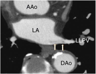 Axial images showing the left lower pulmonary vein thrombus (arrows). AA; ...