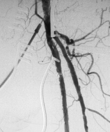 Recanalization by endarterectomy of the superficial femoral artery ostium is ...