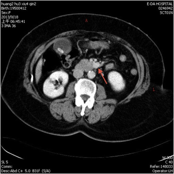 Axial contrast enhanced computed tomography abdomen demonstrated a 1.6-cm ...
