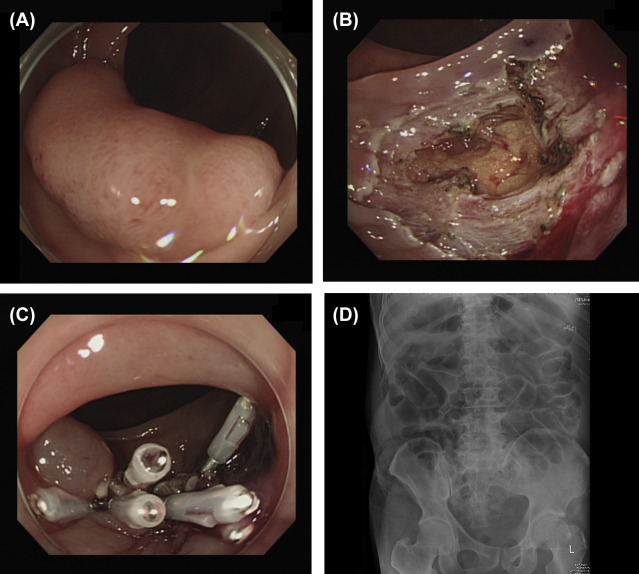Endoscopic submucosal dissection (ESD) perforation. (A) A laterally spreading ...