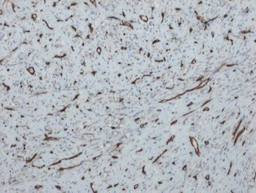 Immunohistochemical image showing CD34-positive spindle cells and vessels.