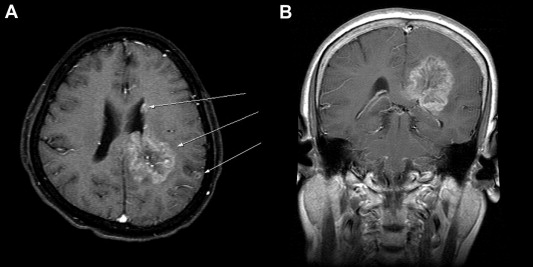 Magnetic resonance imaging of the patients brain. (A) Axial T1-weighted image ...