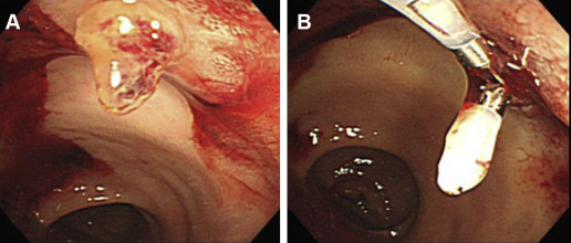 Colonoscopic findings in our elderly patient. (A) Urgent colonoscopy revealed a ...