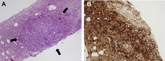 (A) Histological examination shows patchy aggregates of lymphocytes and numerous ...