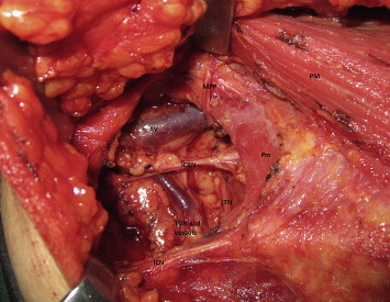 Photograph of right axillary lymph node dissection performed through mastectomy ...