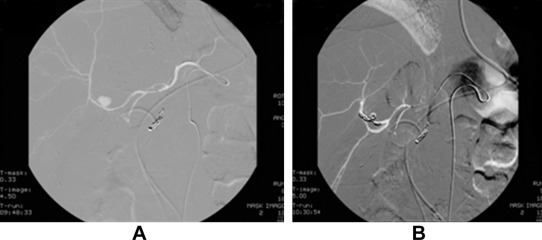 Hepatic artery angiography for Case 1. (A) Pseudoaneurysm arose from the ...