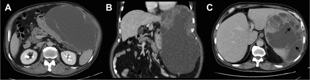 (A and B) Abdominal computed tomography before surgery shows a huge ...
