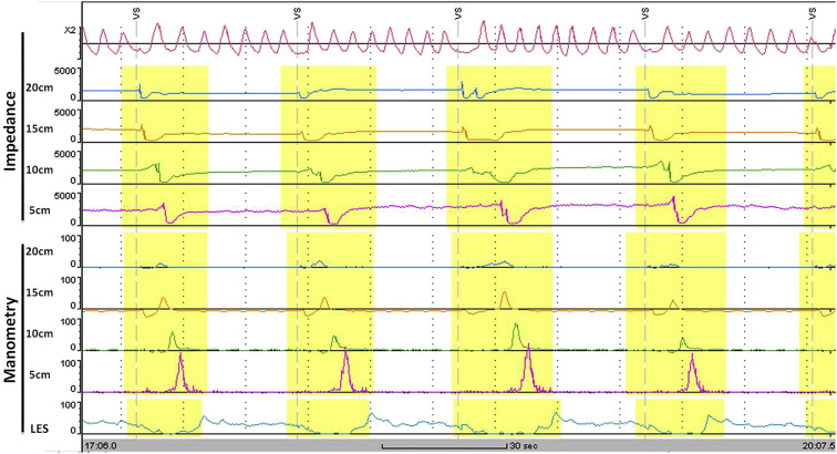 Example of normal impedance tracing of complete bolus transit.