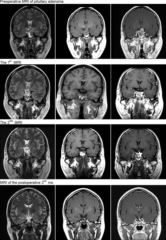 Resection of a large invasive pituitary adenoma under the assistance of ...