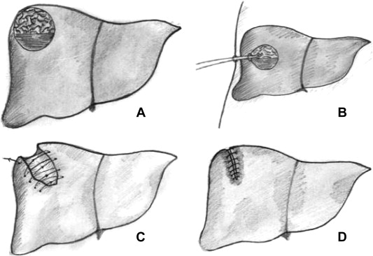 The schematic figure of tube drainage versus capitonnage. (A) The primary cyst. ...