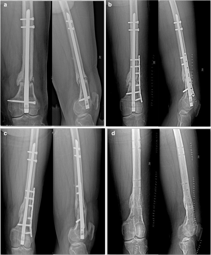 a Distal femoral nonunion after retrograde intramedullary nail of type AO33A2 ;b ...